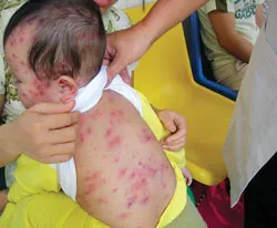TP.HCM gia tăng bệnh nhi mắc bệnh thuỷ đậu 