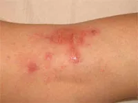 Áp dụng nhiều kỹ thuật mới trong chẩn đóan và điều trị các bệnh về da