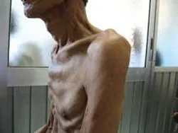 Gia tăng bệnh lao ngoài phổi từ người nhiễm HIV
