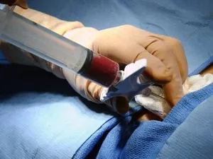 Việt Nam lần đầu tiên thực hiện thành công ca ghép tế bào gốc tạo máu nửa thuận hợp HLA 
