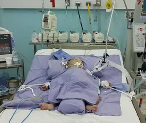 Bé Phi Long bắt đầu tập vật lý trị liệu