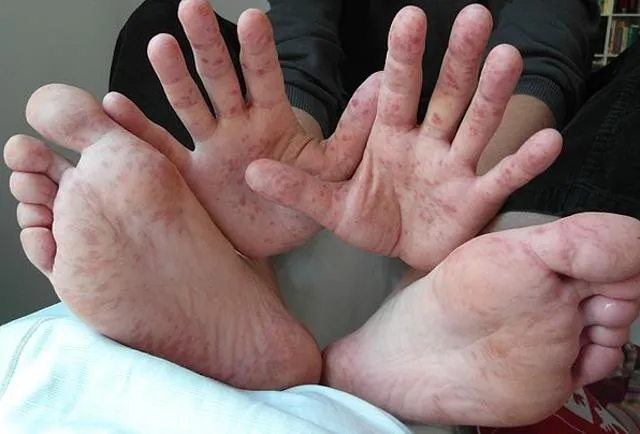 trẻ em dễ mắc bệnh tay chân miệng voh.com.vn