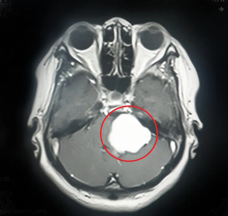 Khối u màng não nằm ở vị trí khó voh.com.vn