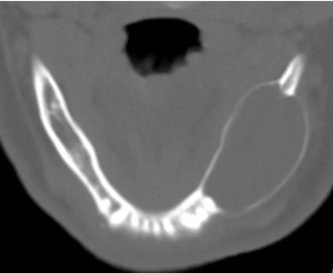 Hình ảnh X – quang khối u nguyên bào men răng voh.com.vn