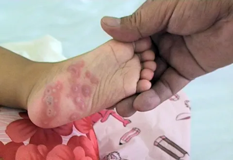 Phòng ngừa các bệnh thường gặp trong mùa mưa