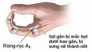 Ngón tay cò súng căn bệnh thường gặp ở phụ nữ có tuổi