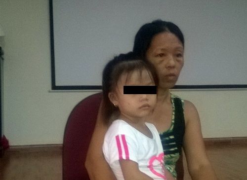 Trẻ bị phỏng thực quản do uống nhầm nước tro tàu