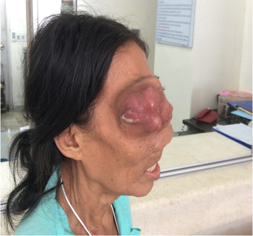 Bệnh nhân bị sarcome sụn vùng mặt, u to lấn chiếm cả mắt