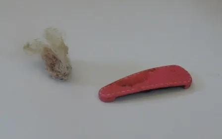 Phát hiện dị vật trong âm đạo bé gái