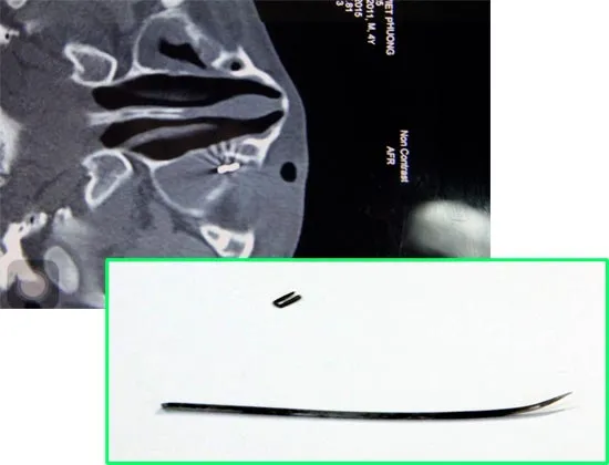 3 lần phẫu thuật mới gắp được dị vật ghim vào hốc mắt