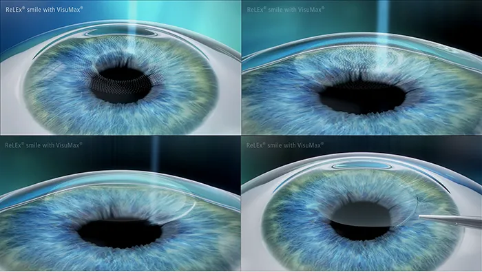 TPHCM: Phẫu thuật điều trị tật khúc xạ mắt bằng phương pháp Femtosecond Lasik