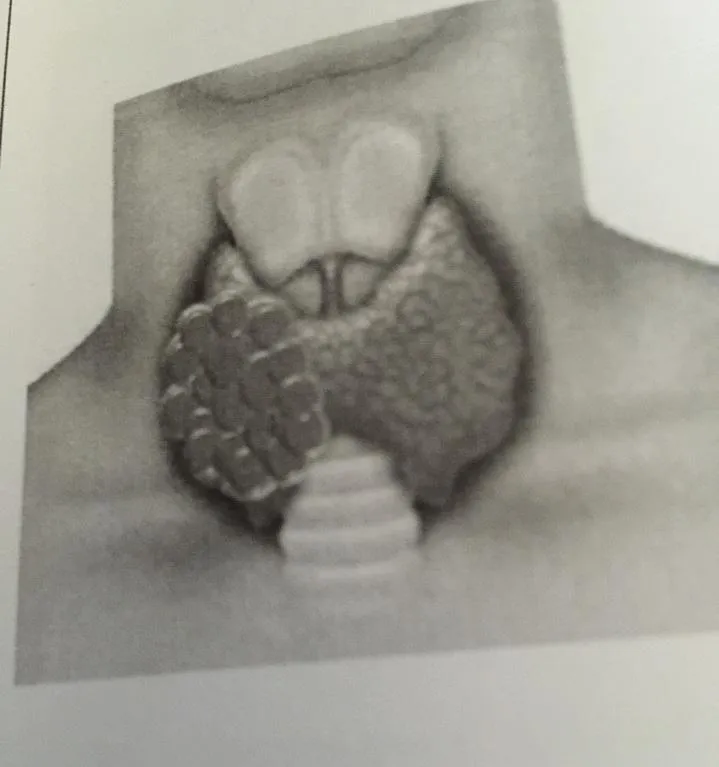 Kỹ thuật mới điều trị bướu cổ bằng sóng cao tần RFA