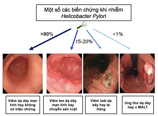 Phát hiện trường hợp nhiễm vi khuẩn HP kháng thuốc