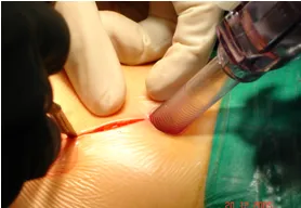 Bệnh viện Chợ Rẫy thực hiện 500 ca ghép thận thành công