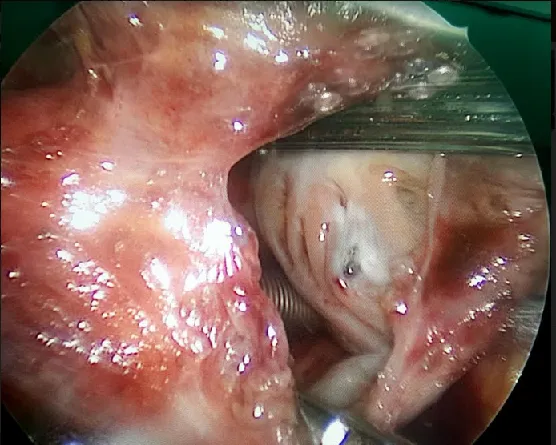 Dị vật nằm trong tim người bệnh suốt 45 năm