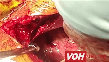 Phẫu thuật cấp cứu thành công trường hợp bị dao đâm thấu tim