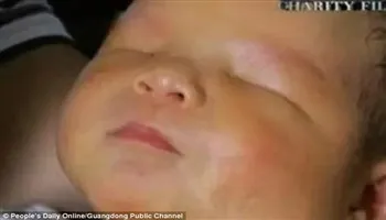 Bệnh hiếm gặp: bé sơ sinh không có nhãn cầu