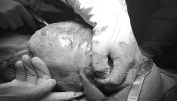 Lấy khối u 2,6 kg trong khoang màng phổi của người bệnh