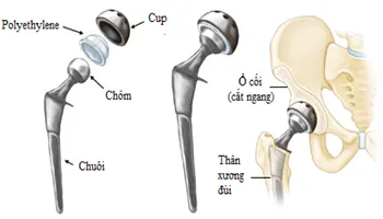 Bệnh viện Bình Tân phẫu thuật thành công thay khớp háng toàn phần