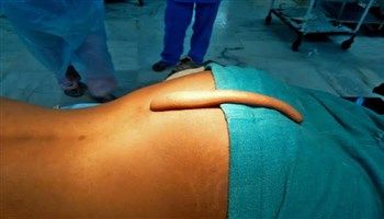 Nam thanh niên đau khổ khi mang cái đuôi sau lưng 18 năm