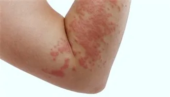 Triệu chứng, nguyên nhân và cách chữa trị mề đay (dị ứng)