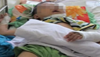 Cứu sống bé trai rơi từ tầng 3 xuống bị hàng rào đâm xuyên ngực