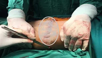 Cứu sống bệnh nhân lòi ruột do tai nạn lao động