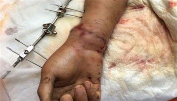 Nối mạch máu và dây thần kinh cho bệnh nhân bị cứa đứt cổ tay