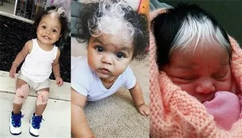 Kỳ lạ bé gái có nhúm tóc trắng bẩm sinh