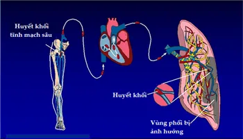 Thuyên tắc phổi: nguyên nhân và cách phòng bệnh
