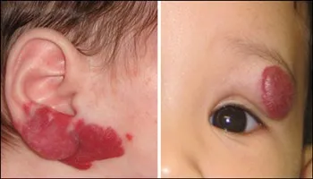 Bác sĩ Mỹ chữa bướu và bướu máu miễn phí cho bệnh nhân Việt Nam