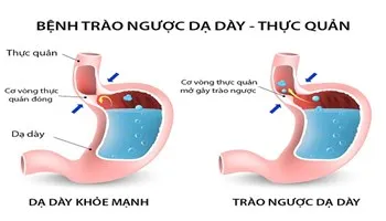 (Phần 1) Trào ngược dạ dày-Nguyên nhân và triệu chứng