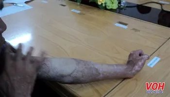 Bệnh nhân bị bỏng xăng 75% cơ thể trở lại cuộc sống bình thường
