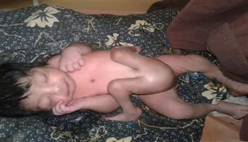 Bé sơ sinh đáng thương có 4 chân và 2 bộ phận sinh dục