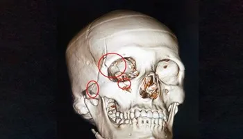 Quy trình báo động đỏ cứu sống người tông vào xe tải