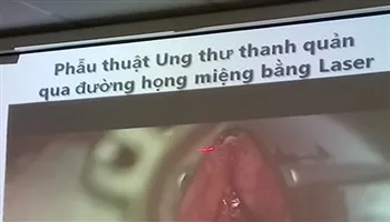 Bệnh viện tai mũi họng triển khai kĩ thuật điều trị ung thư thanh quản bằng laser