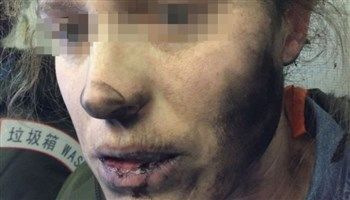 Hành khách phát hoảng vì tai nghe bị nổ, xém da mặt