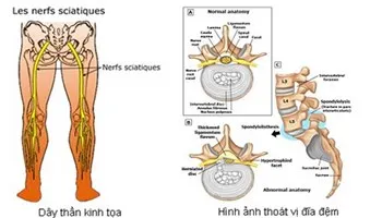 Đau thần kinh tọa: Triệu chứng và cách điều trị