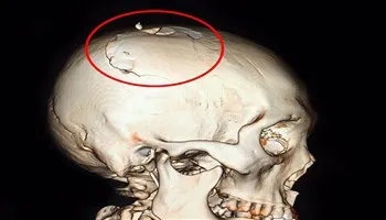 Cứu sống bệnh nhân bị chém vỡ sọ  
