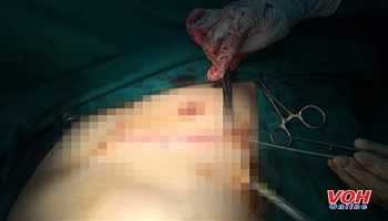 Cứu sống bệnh nhân tự đâm vào tim gây đứt động mạch