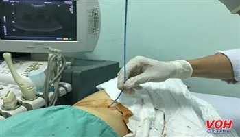 Không phẫu thuật, chỉ cần chọc hút để điều trị nang thận