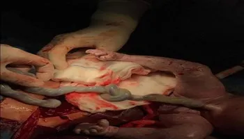 Trường hợp dây rốn thắt nút đầu tiên được phát hiện trong bụng mẹ