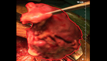 Phẫu thuật lấy khối u trung thất to bằng quả tim