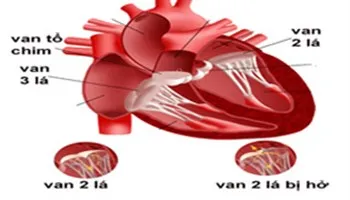 Phẫu thuật thành công bệnh nhi bị hở van hai lá nặng tại tuyến tỉnh