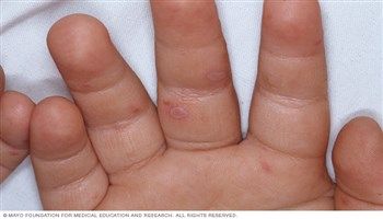 4 giai đoạn bệnh tay chân miệng ở trẻ em và người lớn