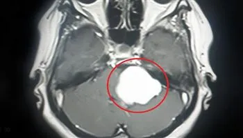 Xử trí u màng não nằm sâu bằng máy hút u siêu âm