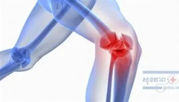 Uống sữa giảm sự phát triển bệnh viêm khớp gối?
