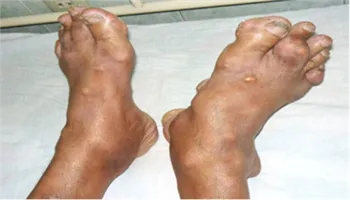 Điều trị bệnh gút hiệu quả: Cần lưu ý