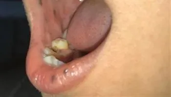 Phát hiện bệnh hiếm nhờ các nốt đen trong miệng
