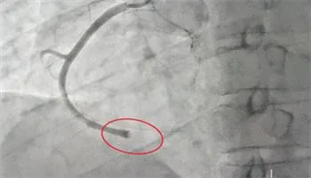Bệnh viện Xuyên Á cứu sống bệnh nhân bị nhồi máu cơ tim cấp không người thân